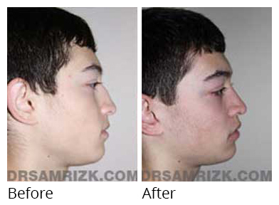 Male face, before and after Rhinoplasty treatment, side view, patient 11