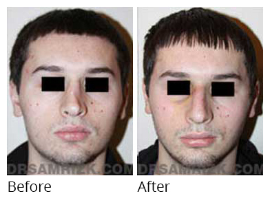 Male face, before and after Rhinoplasty treatment, front view, patient 12