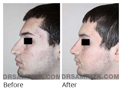 Male face, before and after Rhinoplasty treatment, side view, patient 12