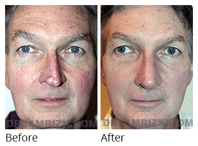 Male face, before and after Rhinoplasty treatment, front view, patient 13