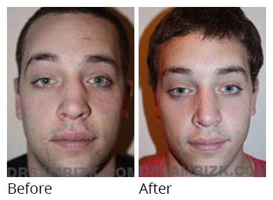 Male face, before and after Rhinoplasty treatment, front view, patient 15