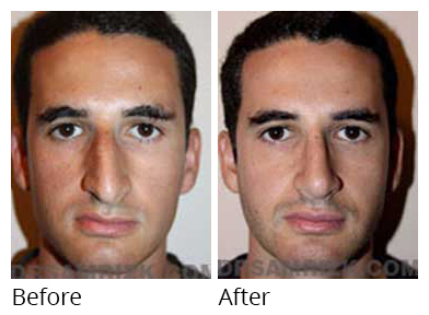 Male face, before and after Rhinoplasty treatment, front view, patient 16