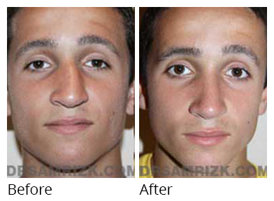 Male face, before and after Rhinoplasty treatment, front view, patient 17