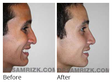 Male face, before and after Rhinoplasty treatment, side view, patient 17