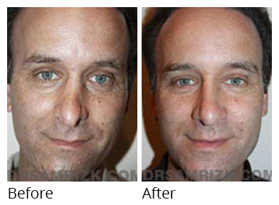 Male face, before and after Rhinoplasty treatment, front view, patient 18