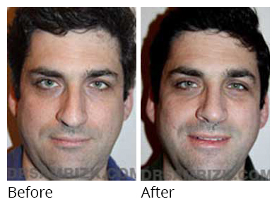 Male face, before and after Rhinoplasty treatment, front view, patient 19