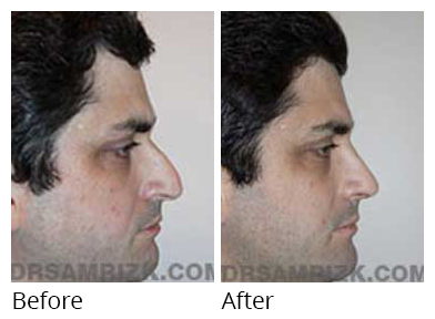 Male face, before and after Rhinoplasty treatment, side view, patient 19