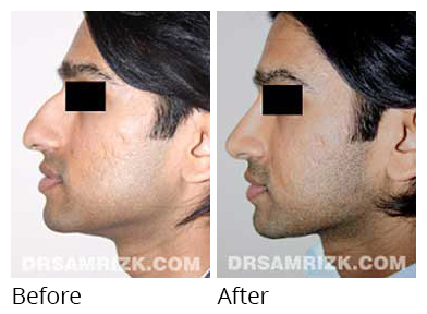 Male face, before and after Rhinoplasty treatment, side view, patient 20