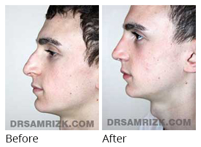 Male face, before and after Rhinoplasty treatment, side view, patient 21