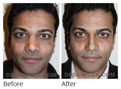Male face, before and after Rhinoplasty treatment, front view, patient 22