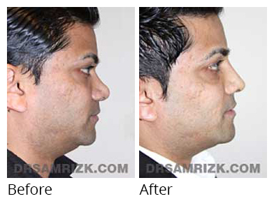 Male face, before and after Rhinoplasty treatment, side view, patient 22