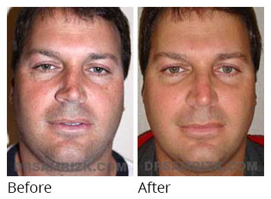 Male face, before and after Rhinoplasty treatment, front view, patient 23