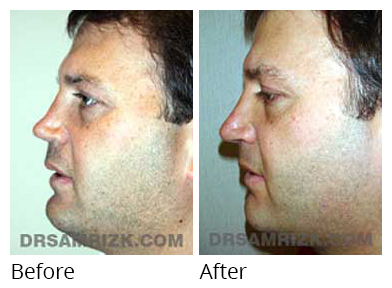 Male face, before and after Rhinoplasty treatment, side view, patient 23