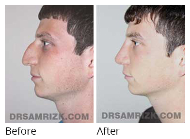Male face, before and after Rhinoplasty treatment, side view, patient 24
