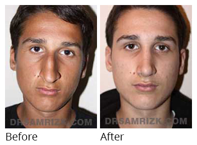 Male face, before and after Rhinoplasty treatment, front view, patient 25