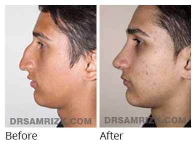 Male face, before and after Rhinoplasty treatment, side view, patient 25
