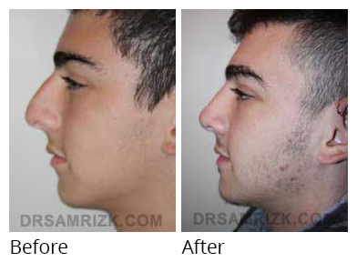 Male face, before and after Rhinoplasty treatment, side view, patient 26