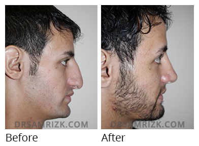 Male face, before and after Rhinoplasty treatment, r-side view, patient 28