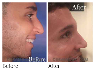Male face, before and after Rhinoplasty treatment, r-side view, patient 30