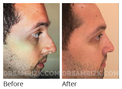 Male face, before and after Rhinoplasty treatment, r-side view, patient 31