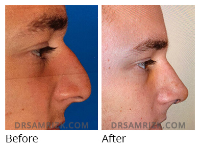 Male face, before and after Rhinoplasty treatment, r-side view, patient 32