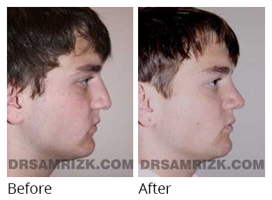 Male face, before and after Rhinoplasty treatment, r-side view, patient 33