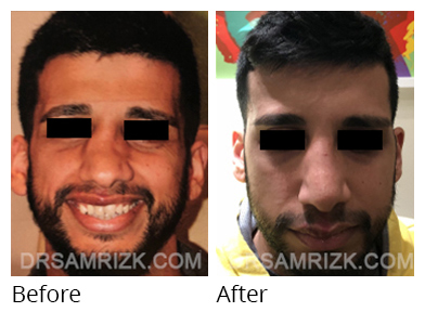 Male face, before and after Rhinoplasty treatment, front view, patient 34