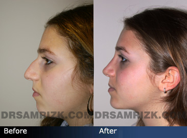 Nose Job before and after side photo