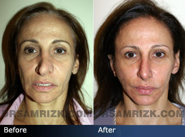 revision rhinoplasty before & after - front photos