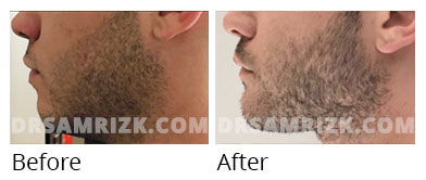 Man's face, before and after Chin and cheek treatment, front view, patient 10