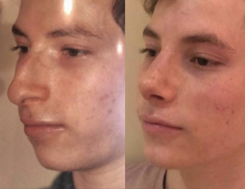 Male face, Before and After Plastic Surgery Treatment, right side view, patient 2
