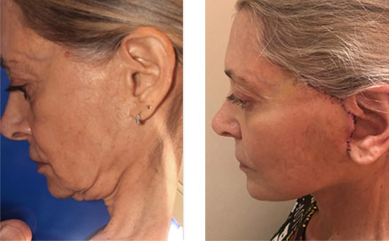 Patient 11 Set1 before and after nose surgery