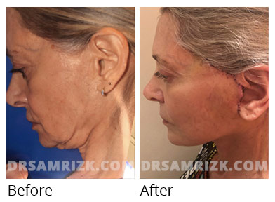 Female face, before and after deep plane facelift