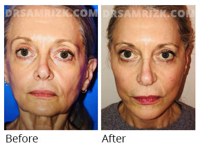 Female face, before and after deep plane facelift