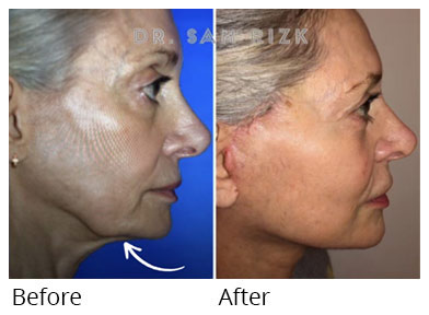 Female face, before and after deep plane facelift