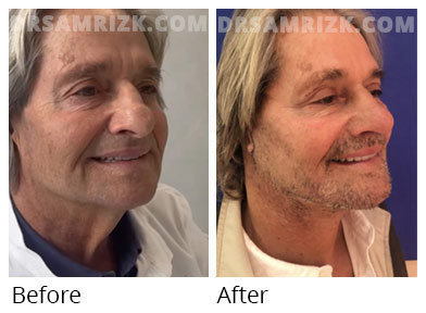 Male face, before and after facelift