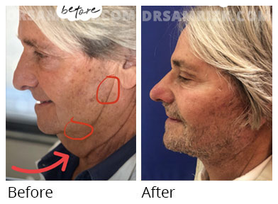 Male face, before and after  facelift