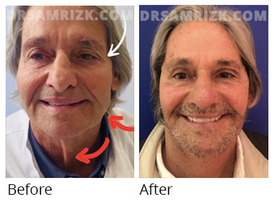 Male face, before and after  facelift