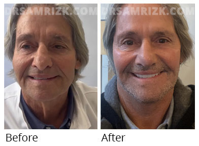 Male face, before and after  facelift