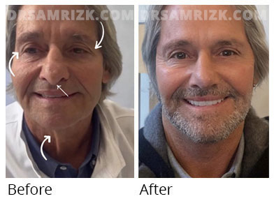 Male face, before and after  facelift