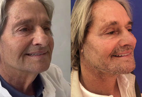 male Before and After Facelift Surgery