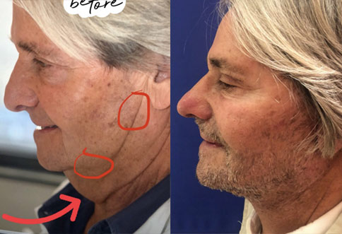 male patient Before and After Facelift Surgery