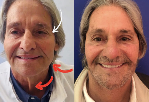 photos male patient  Before and After Facelift
