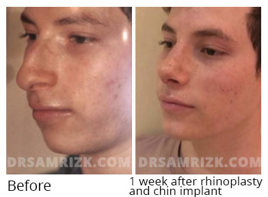 Male face, before and after Rhinoplasty treatment, side view, patient 36