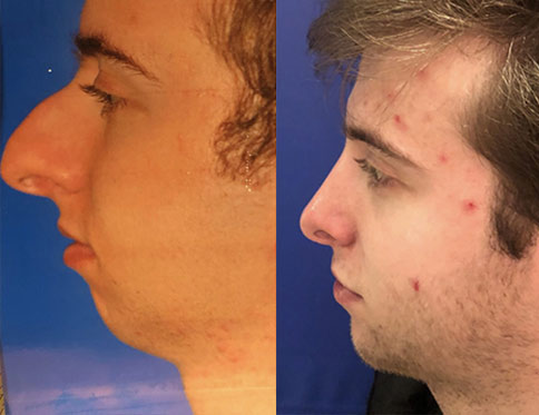 Male face, Before and After Plastic Surgery Treatment, right side view, patient 3
