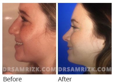 Female face, before and after Rhinoplasty treatment, front view, patient 55
