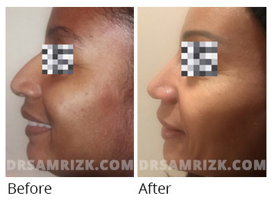 Female face, before and after Rhinoplasty treatment, front view, patient 56
