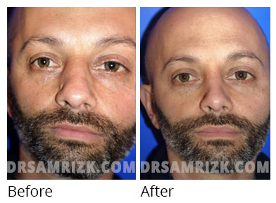 Male face, before and after Rhinoplasty treatment, front view, patient 37