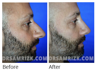 Male face, before and after Rhinoplasty treatment, side view, patient 37