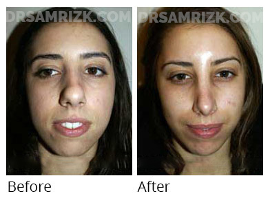 Woman's face, before and after Chin and cheek treatment, front view, patient 2